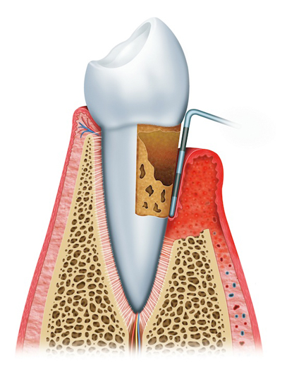 Stages of Gum Disease Merced, CA