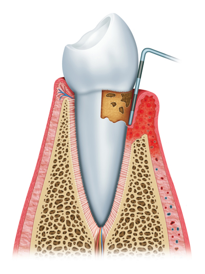 Stages of Gum Disease Merced, CA